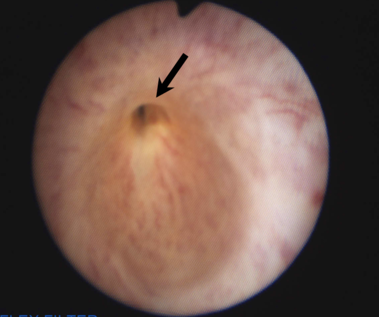 Diagnosis Of Urethral Stricture